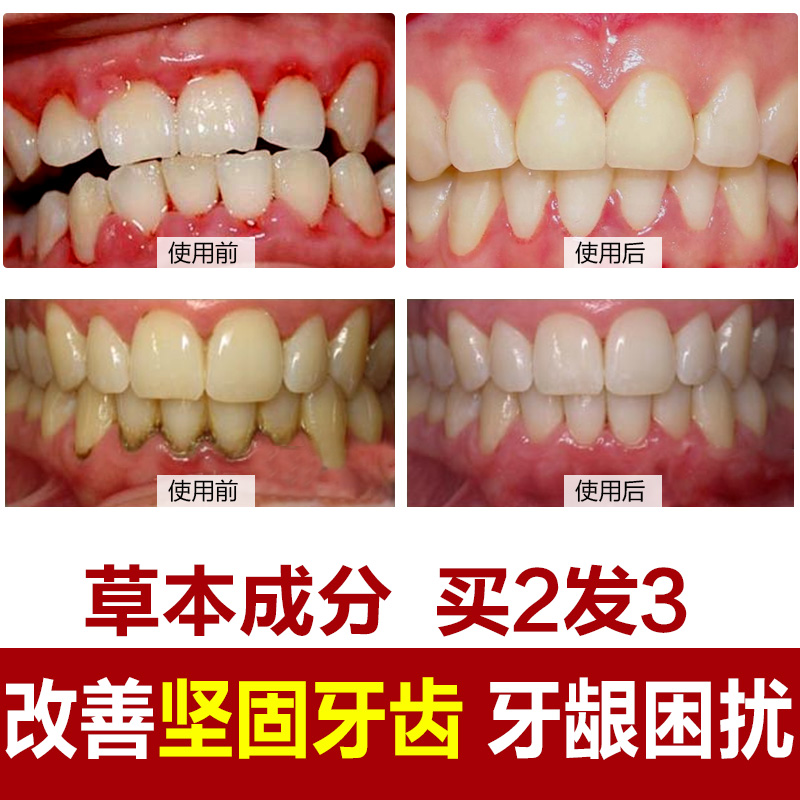 固齿散牙齿松动 非牙周炎牙龈出血牙龈萎缩美白牙齿去牙渍牙结石